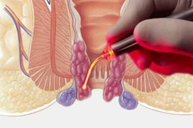 Laser Treatment for Piles---01