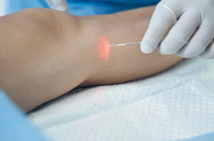 Laser Treatment for Varicose Veins---01